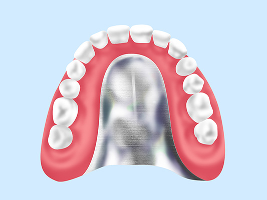 金属床義歯（チタン・コバルトクロム）
