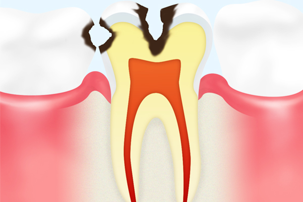 C2 【象牙質の虫歯】