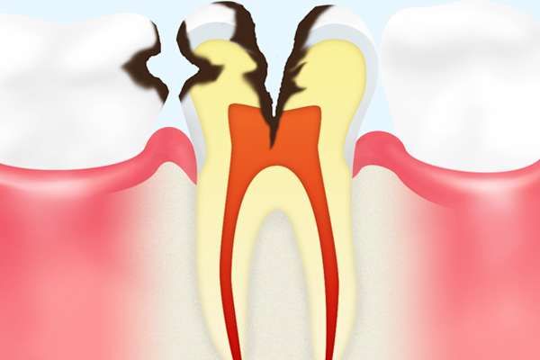 C3 【神経まで達した虫歯】