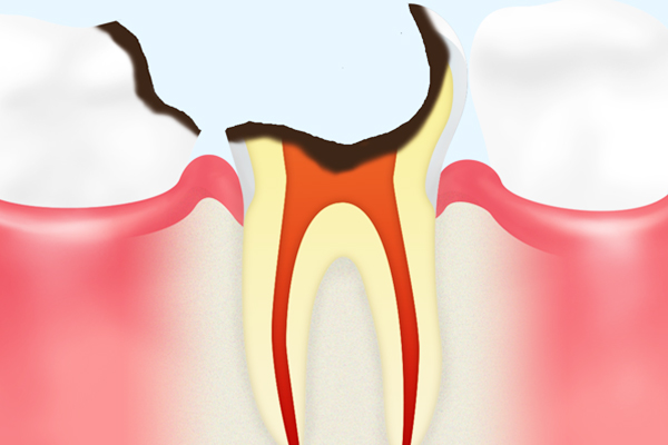 C4 【歯根まで達した虫歯】